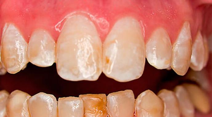 Почему возникает и как развивается флюороз зубов: фото заболевания, симптоматика и правила лечения